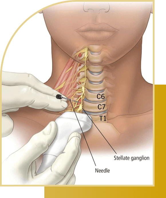 Stellate ganglio