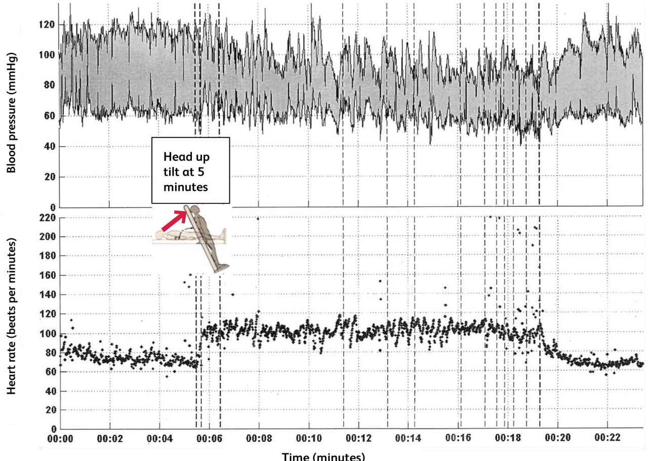 Autonomic dysfunction physiology and management strategies