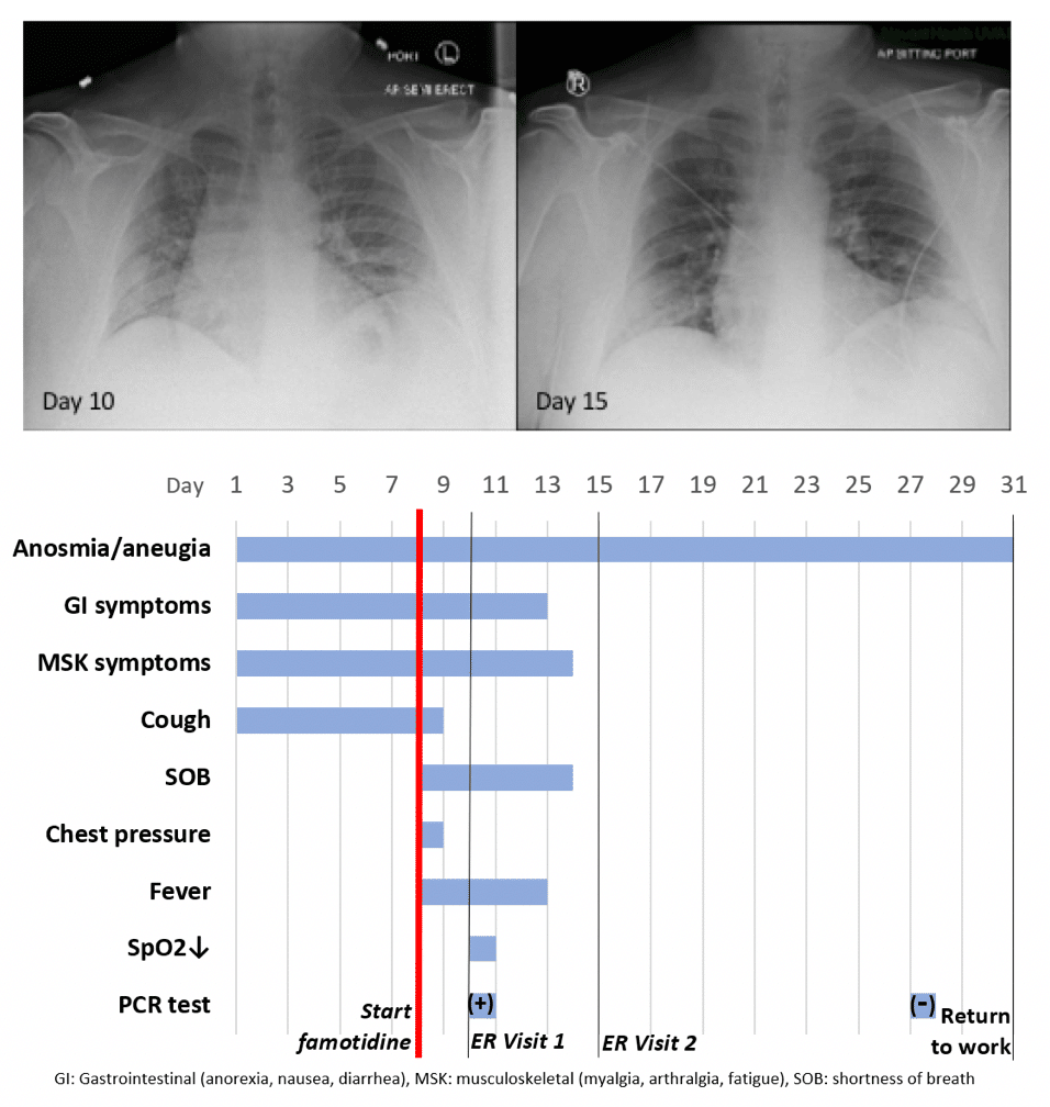 SARS-CoV-2 infection