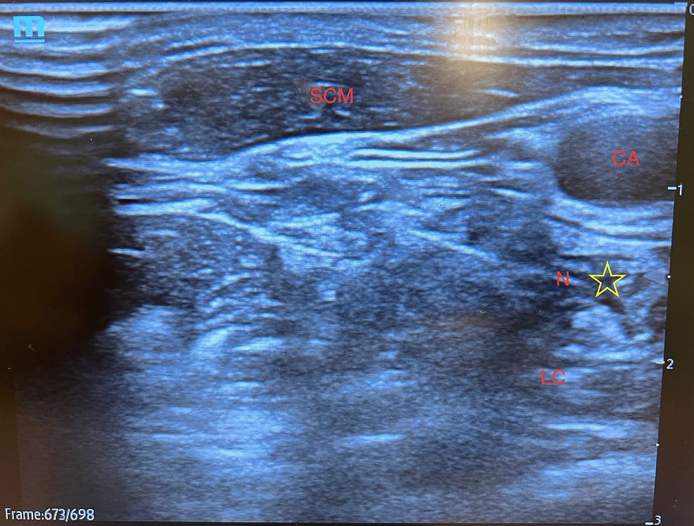 Stellate Ganglion Block for Long COVID Symptom Management