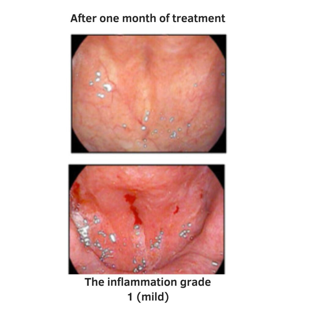 Epipharyngeal Abrasive Therapy | after