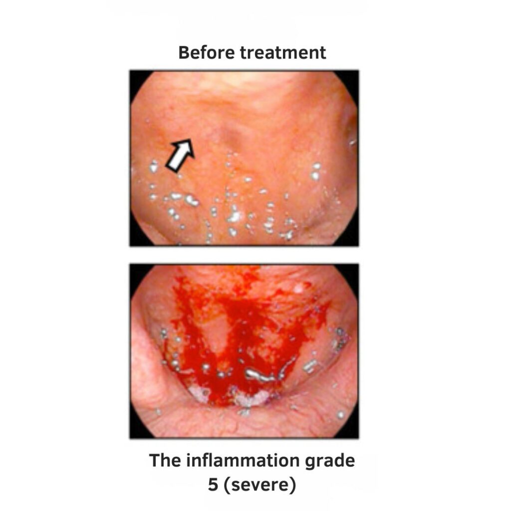 Epipharyngeal Abrasive Therapy | before